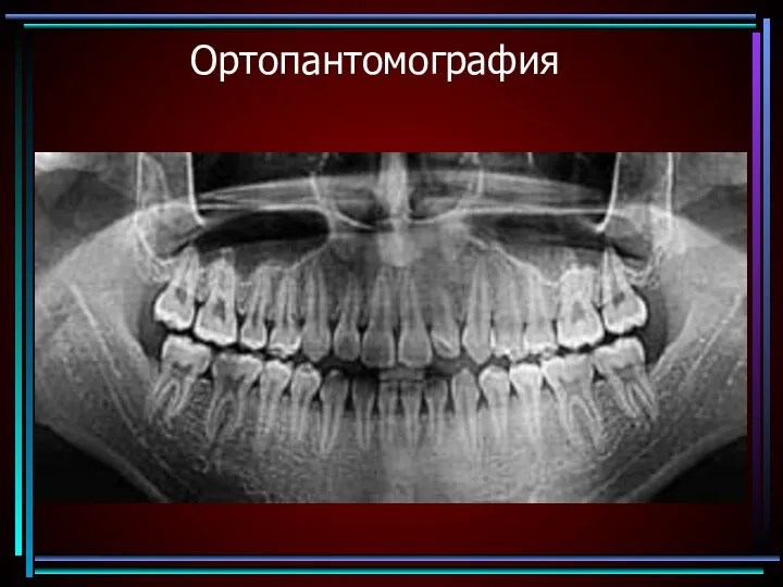 Ортопантомография