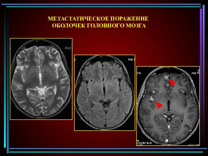 МЕТАСТАТИЧЕСКОЕ ПОРАЖЕНИЕ ОБОЛОЧЕК ГОЛОВНОГО МОЗГА