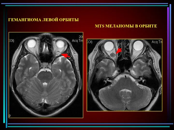 ГЕМАНГИОМА ЛЕВОЙ ОРБИТЫ MTS МЕЛАНОМЫ В ОРБИТЕ