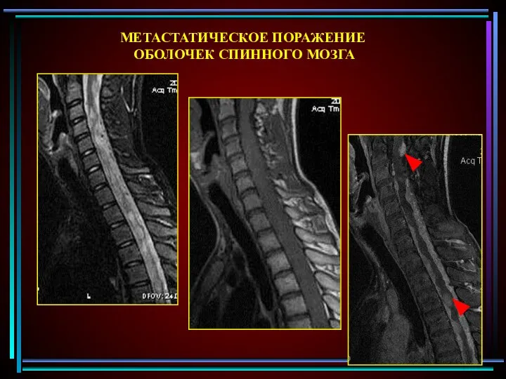 МЕТАСТАТИЧЕСКОЕ ПОРАЖЕНИЕ ОБОЛОЧЕК СПИННОГО МОЗГА