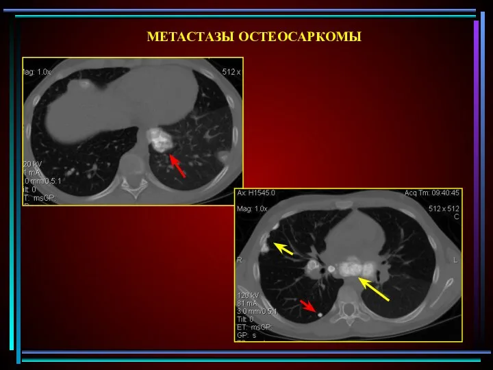 МЕТАСТАЗЫ ОСТЕОСАРКОМЫ