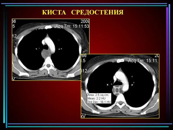 КИСТА СРЕДОСТЕНИЯ