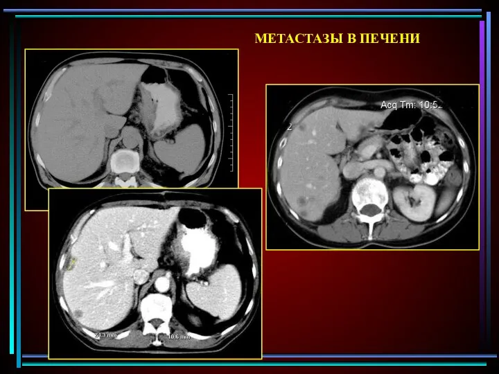 МЕТАСТАЗЫ В ПЕЧЕНИ