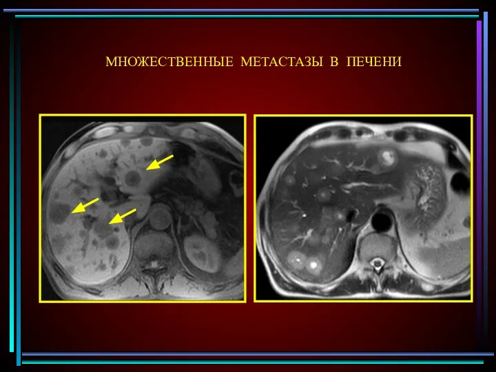 МНОЖЕСТВЕННЫЕ МЕТАСТАЗЫ В ПЕЧЕНИ