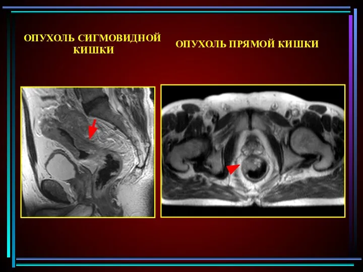 ОПУХОЛЬ СИГМОВИДНОЙ КИШКИ ОПУХОЛЬ ПРЯМОЙ КИШКИ
