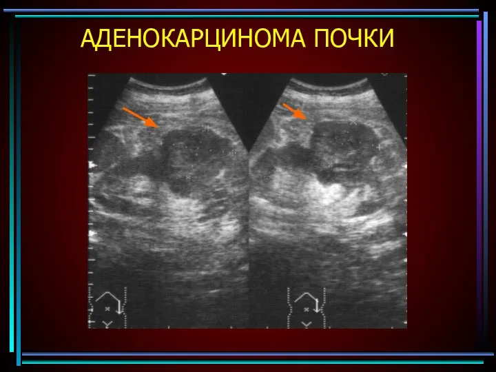 АДЕНОКАРЦИНОМА ПОЧКИ