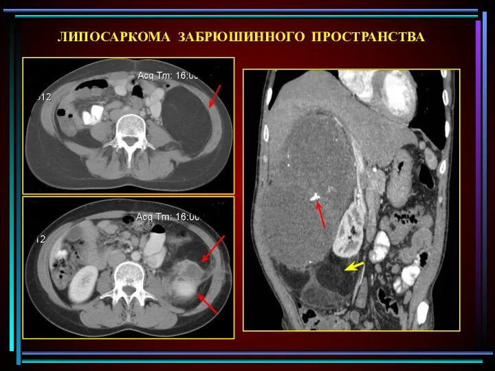 ЛИПОСАРКОМА ЗАБРЮШИННОГО ПРОСТРАНСТВА