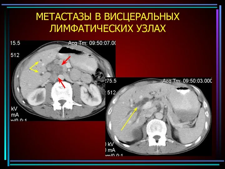 МЕТАСТАЗЫ В ВИСЦЕРАЛЬНЫХ ЛИМФАТИЧЕСКИХ УЗЛАХ