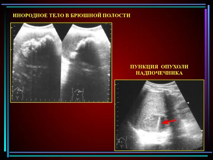 ИНОРОДНОЕ ТЕЛО В БРЮШНОЙ ПОЛОСТИ ПУНКЦИЯ ОПУХОЛИ НАДПОЧЕЧНИКА