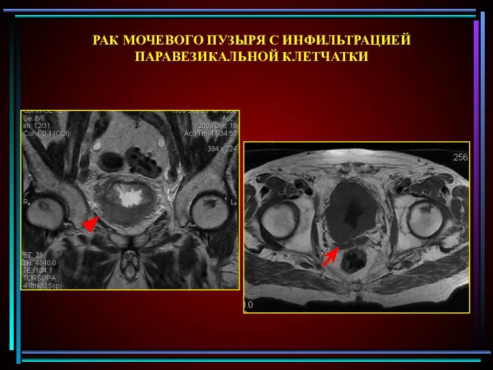 РАК МОЧЕВОГО ПУЗЫРЯ С ИНФИЛЬТРАЦИЕЙ ПАРАВЕЗИКАЛЬНОЙ КЛЕТЧАТКИ