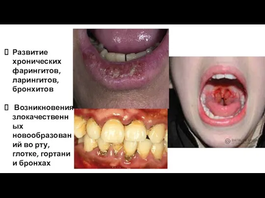 Развитие хронических фарингитов, ларингитов, бронхитов Возникновения злокачественных новообразований во рту, глотке, гортани и бронхах