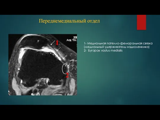 Переднемедиальный отдел 1- Медиальная пателло-феморальная связка (медиальный удерживатель надколенника) 2- Бугорок vastus medialis