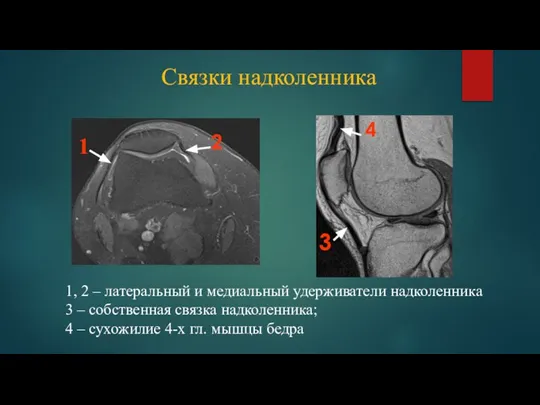 Связки надколенника 1, 2 – латеральный и медиальный удерживатели надколенника 3 –