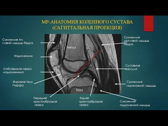 МР-АНАТОМИЯ КОЛЕННОГО СУСТАВА (САГИТТАЛЬНАЯ ПРОЕКЦИЯ) Femur Tibia