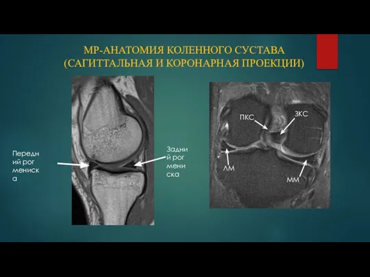 МР-АНАТОМИЯ КОЛЕННОГО СУСТАВА (САГИТТАЛЬНАЯ И КОРОНАРНАЯ ПРОЕКЦИИ) ПКС ЗКС ММ ЛМ