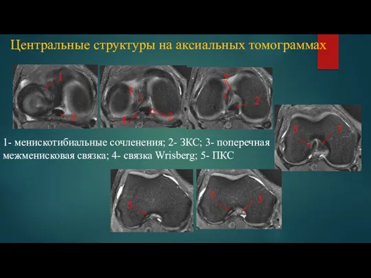 Центральные структуры на аксиальных томограммах 1- менискотибиальные сочленения; 2- ЗКС; 3- поперечная