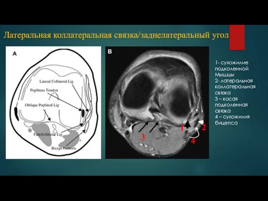 Латеральная коллатеральная связка/заднелатеральный угол 1- сухожилие подколенной Мышцы 2- латеральная коллатеральная связка