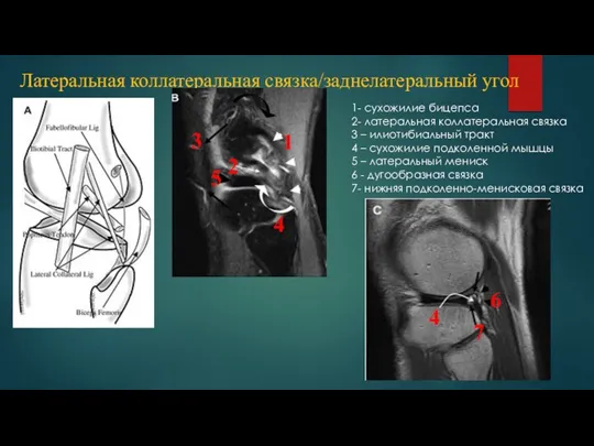 Латеральная коллатеральная связка/заднелатеральный угол 1- сухожилие бицепса 2- латеральная коллатеральная связка 3