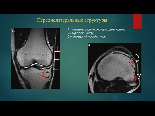 Переднелатеральные структуры 1 - Латеральная коллатеральная связка 2 - бугорок Gerdy 3 – передний косой пучок