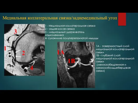 1 - Медиальная коллатеральная связка 2 – задняя косая связка 3 –