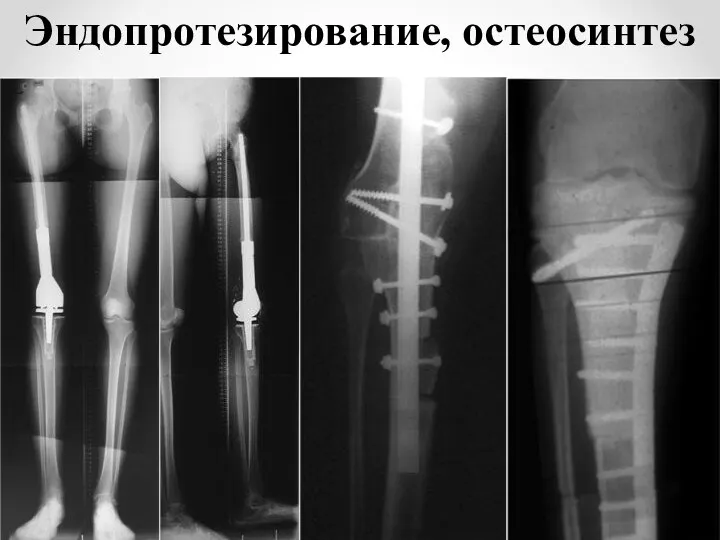 Эндопротезирование, остеосинтез