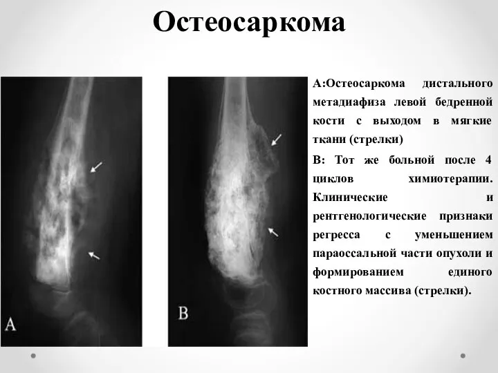 Остеосаркома A:Остеосаркома дистального метадиафиза левой бедренной кости с выходом в мягкие ткани