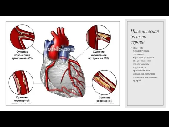 Ишемическая болезнь сердца ИБС – это патологическое состояние, характеризующееся абсолютным или относительным