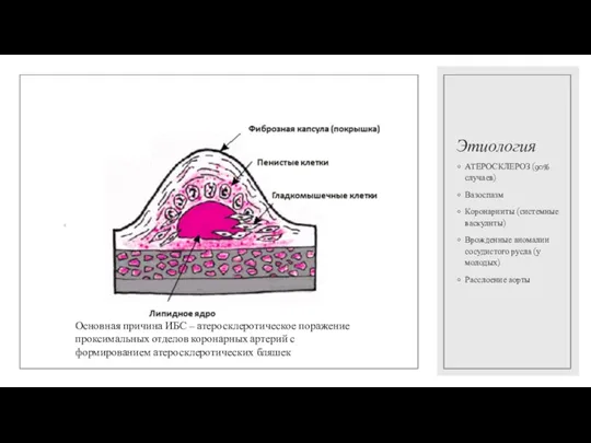 Этиология АТЕРОСКЛЕРОЗ (90% случаев) Вазоспазм Коронарииты (системные васкулиты) Врожденные аномалии сосудистого русла