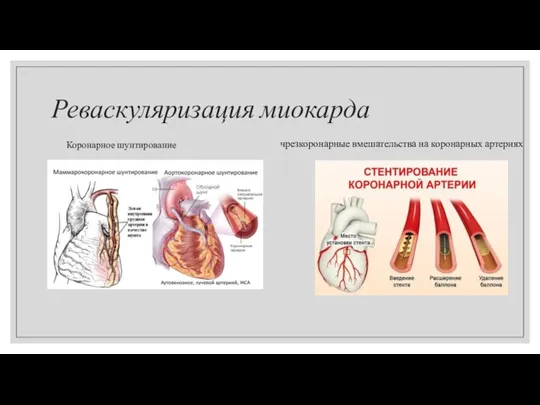 Реваскуляризация миокарда Коронарное шунтирование чрезкоронарные вмешательства на коронарных артериях