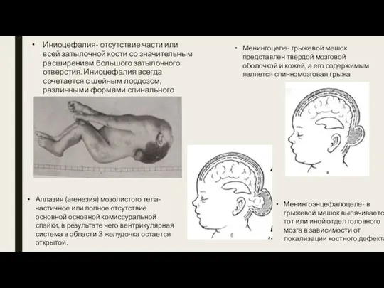 Иниоцефалия- отсутствие части или всей затылочной кости со значительным расширением большого затылочного