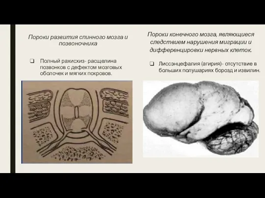 Пороки развития спинного мозга и позвоночника Полный рахисхиз- расщелина позвонков с дефектом