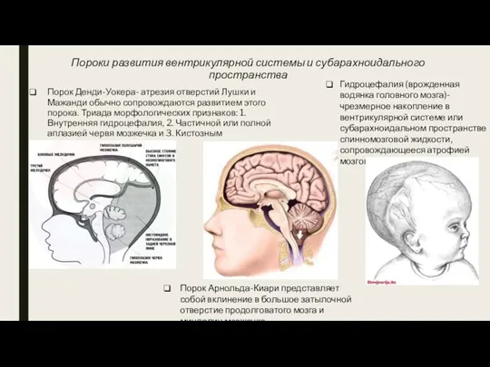 Пороки развития вентрикулярной системы и субарахноидального пространства Порок Денди-Уокера- атрезия отверстий Лушки