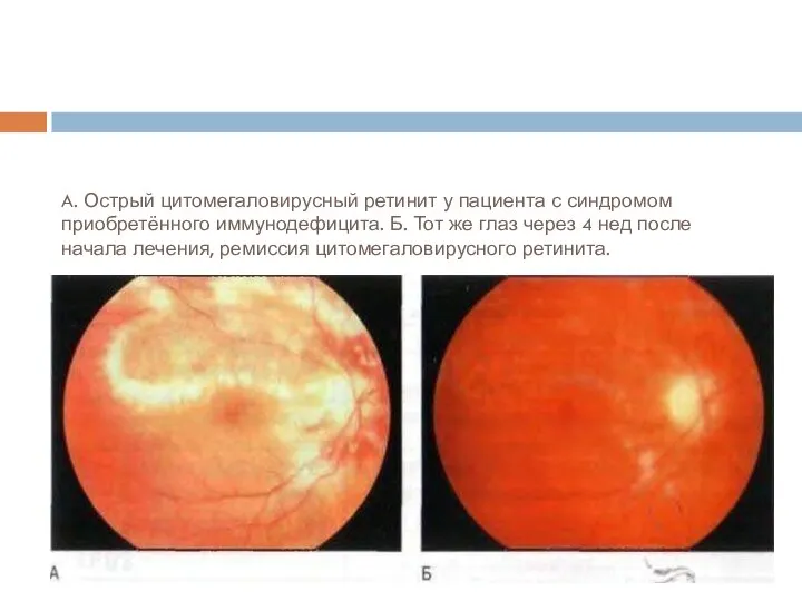 A. Острый цитомегаловирусный ретинит у пациента с синдромом приобретённого иммунодефицита. Б. Тот