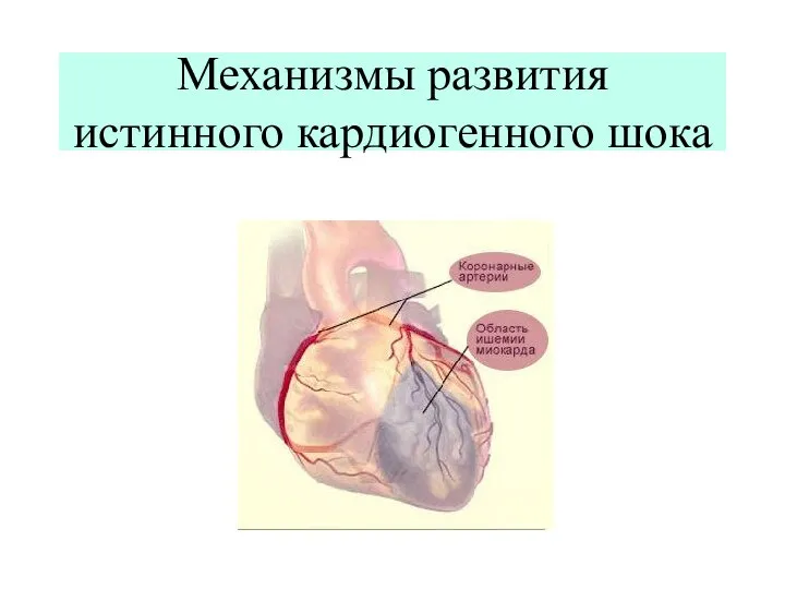 Механизмы развития истинного кардиогенного шока