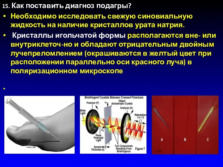 15. Как поставить диагноз подагры? Необходимо исследовать свежую синовиальную жидкость на наличие