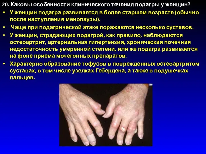 20. Каковы особенности клинического течения подагры у женщин? У женщин подагра развивается