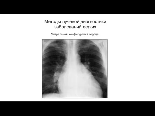 АКТУАЛЬНЫЕ ВОПРОСЫ РЕНТГЕНОЛОГИИ Методы лучевой диагностики заболеваний легких Митральная конфигурация сердца