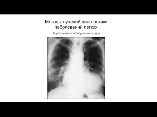 АКТУАЛЬНЫЕ ВОПРОСЫ РЕНТГЕНОЛОГИИ Методы лучевой диагностики заболеваний легких Аортальная конфигурация сердца