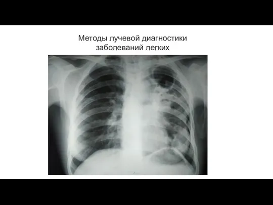 АКТУАЛЬНЫЕ ВОПРОСЫ РЕНТГЕНОЛОГИИ Методы лучевой диагностики заболеваний легких