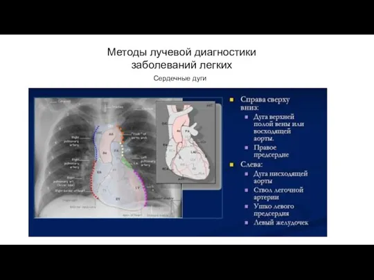 АКТУАЛЬНЫЕ ВОПРОСЫ РЕНТГЕНОЛОГИИ Методы лучевой диагностики заболеваний легких Сердечные дуги