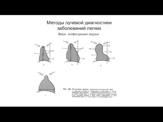 АКТУАЛЬНЫЕ ВОПРОСЫ РЕНТГЕНОЛОГИИ Методы лучевой диагностики заболеваний легких Виды конфигурации сердца