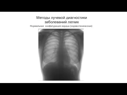 АКТУАЛЬНЫЕ ВОПРОСЫ РЕНТГЕНОЛОГИИ Методы лучевой диагностики заболеваний легких Нормальная конфигурация сердца (нормостеническая)