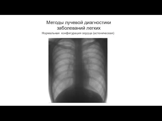 АКТУАЛЬНЫЕ ВОПРОСЫ РЕНТГЕНОЛОГИИ Методы лучевой диагностики заболеваний легких Нормальная конфигурация сердца (астеническая)