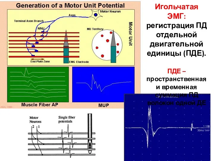 Игольчатая ЭМГ: регистрация ПД отдельной двигательной единицы (ПДЕ). ПДЕ – пространственная и