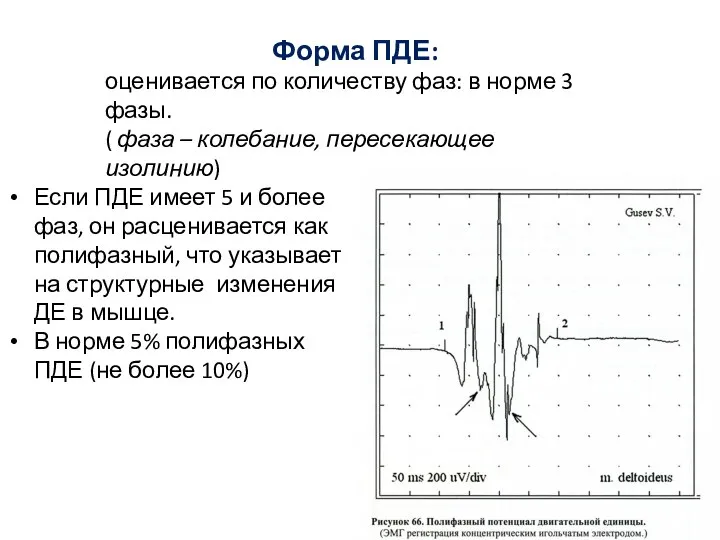 Форма ПДЕ: оценивается по количеству фаз: в норме 3 фазы. ( фаза