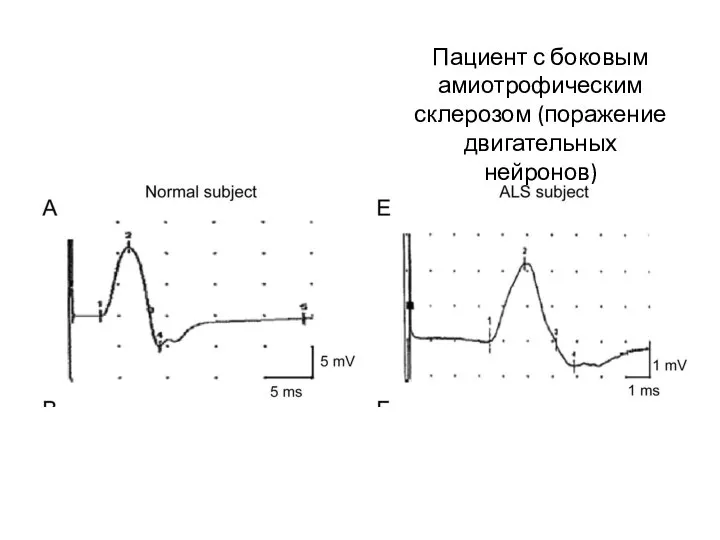 Пациент с боковым амиотрофическим склерозом (поражение двигательных нейронов)