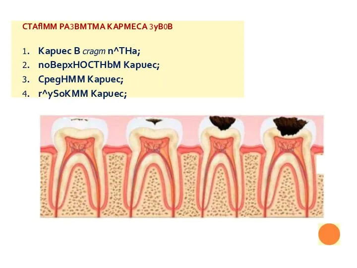 CTAflMM PA3BMTMA KAPMECA 3yB0B 1. Kapuec B cragm n^THa; 2. noBepxHOCTHbM Kapuec;