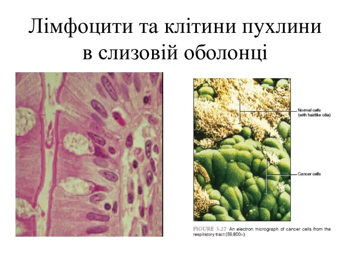 Лімфоцити та клітини пухлини в слизовій оболонці