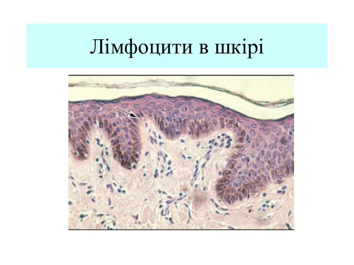 Лімфоцити в шкірі