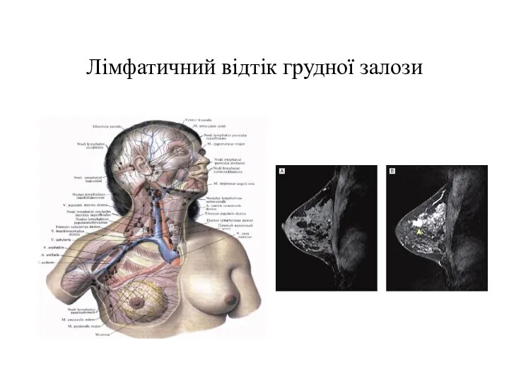 Лімфатичний відтік грудної залози